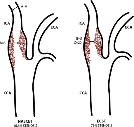 Schéma comparatif ECST vs NASCET
