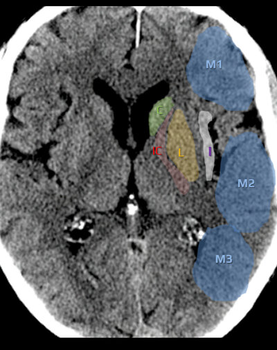 ASPECTS — Coupe ganglions de la base : C, L, IC, I, M1, M2, M3
