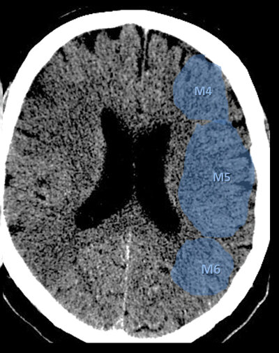 ASPECTS — Coupe supra-ganglionnaire : M4, M5, M6