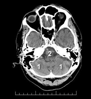 pc-ASPECTS — Niveau pontique : P (pont), C (cervelet)