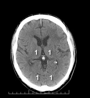 pc-ASPECTS — Niveau thalamique : T (thalamus), OL (lobe occipital)