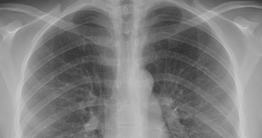 Bronchial Carcinoid