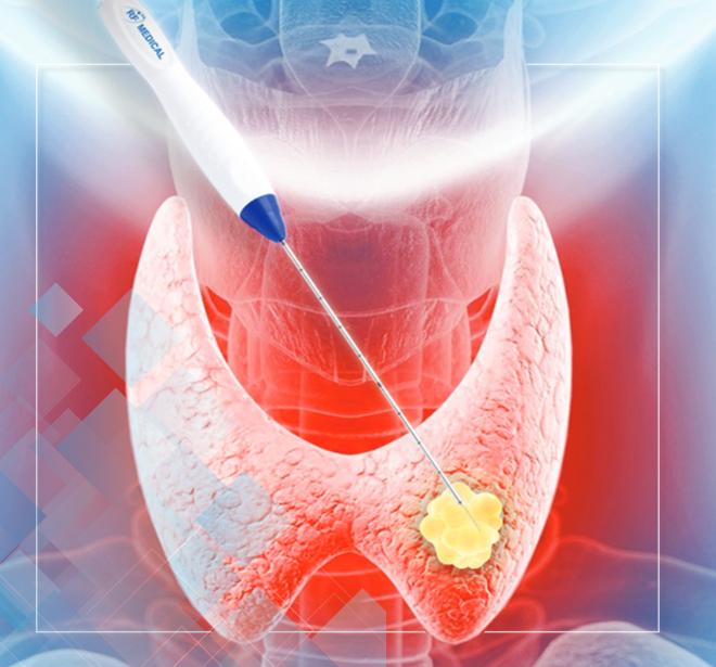 Bronchial Carcinoid